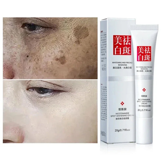 Effective Whiten Freckle Cream Brighten Face Remove Dark Face Spot Melasma Anti-pigmentation Improve Dullness Skin Care Cream